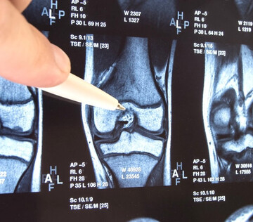 Новую технологию лечения патологии коленного сустава начали использовать в Сеченовском университете
