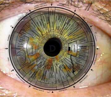 О болезнях почек можно узнать по состоянию сетчатки глаз
