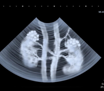 В России выявили, какие механизмы в работе клеток мешают восстановлению почек