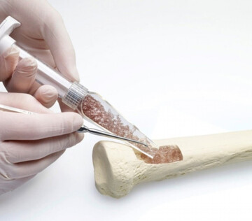 В России создали уникальный гель для регенерации костной ткани