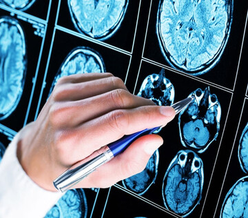 Препарат от давления остановил рост гиобластомы