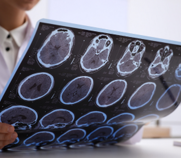 Искусственный интеллект поможет московским врачам распознать рассеянный склероз
