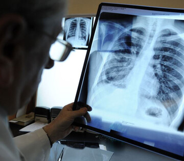 Редкое заболевание легих начнут диагностировать по выдыхаемому воздуху