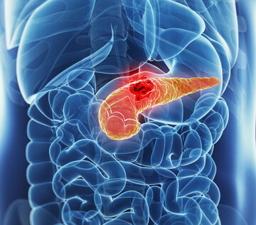 Разработана терапия против сахарной "маскировки" рака поджелудочной железы